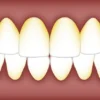 Cara Jitu Hilangkan Karang Gigi yang Membandel