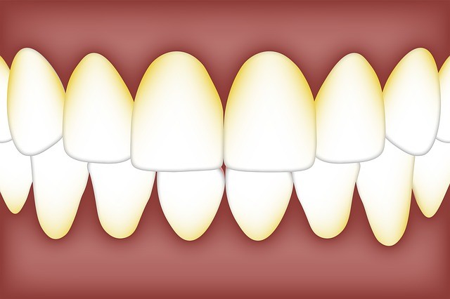 Cara Jitu Hilangkan Karang Gigi yang Membandel