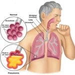 7 Gejala Umum Pneumonia: Penyakit Paru-paru Menular yang Mewabah di China