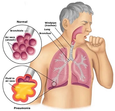 7 Gejala Umum Pneumonia: Penyakit Paru-paru Menular yang Mewabah di China