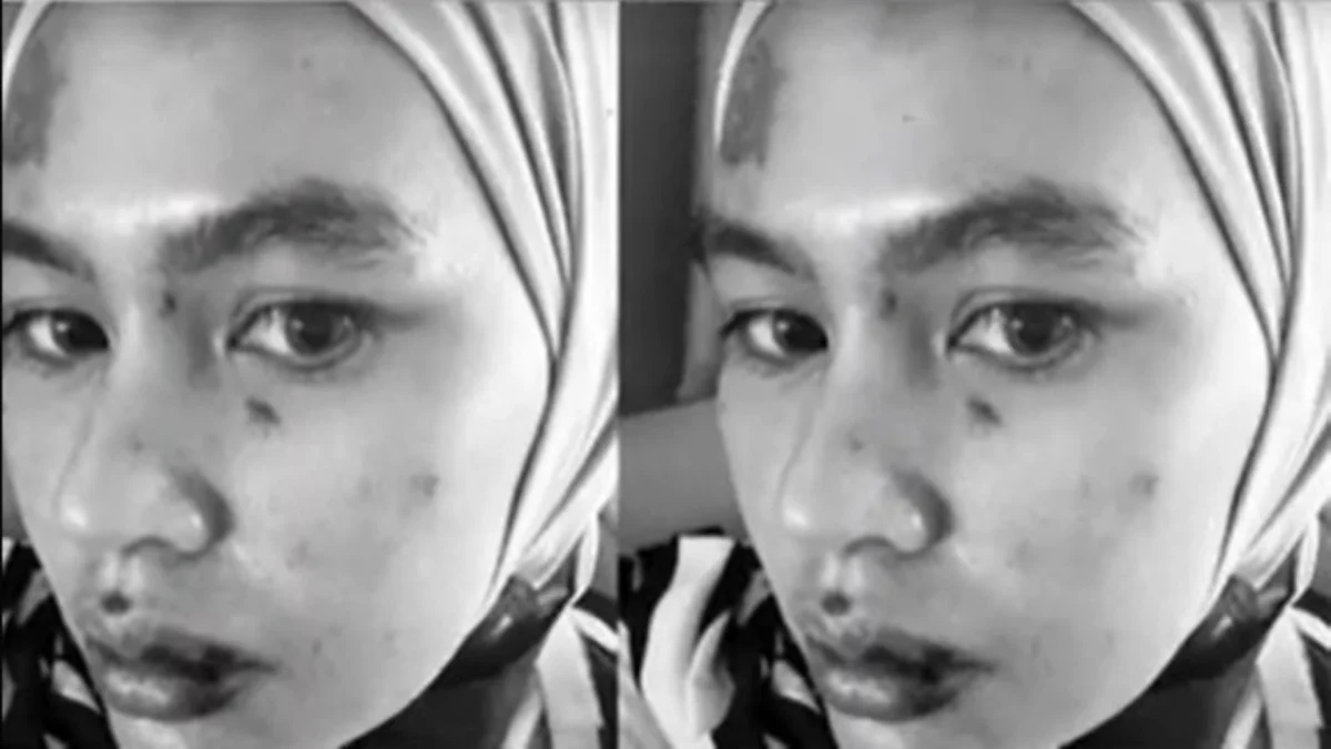 Kartika Putri Mengalami Masalah Kulit Serius, Wajah Melepuh, Netizen Ingatkan Untuk Menjaga Ucapan